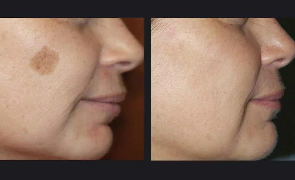 Frax Treatment Results